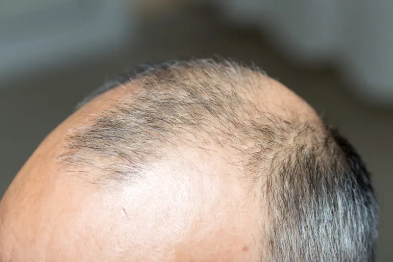 male baldness