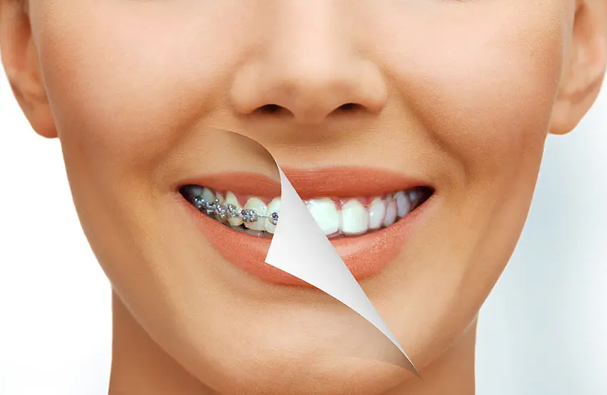 braces
