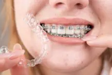 Orthodontic treatment has been synonymous with metal braces for many years. They are effective. But traditional brackets often carried a social stigma which is particularly so for adults.