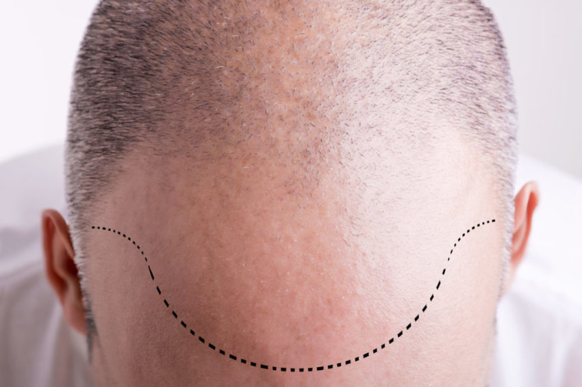Hair Loss