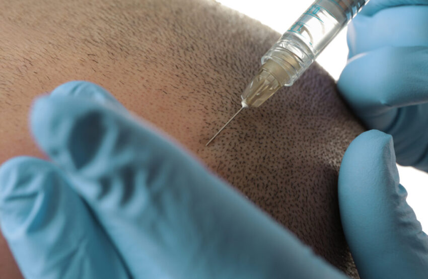 Hair Transplant