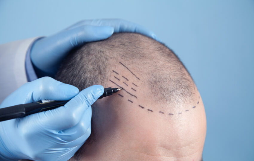 Patient,Suffering,From,Hair,Loss,In,Consultation,With,A,Doctor.