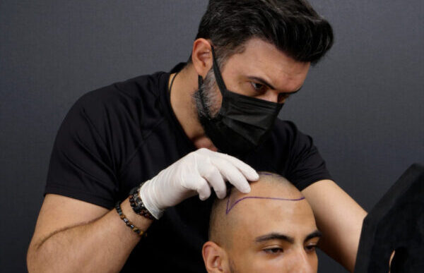 Vera Clinic is the go-to place for hair transplant Turkey surgery. We provide the highest level of care at Vera Clinic.